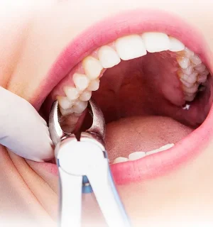 Фото для Сложное удаление зуба
