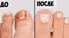 Удаление вросшего ногтя с коррекцией