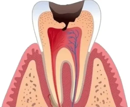 Фото для Лечение пульпита постоянного зуба