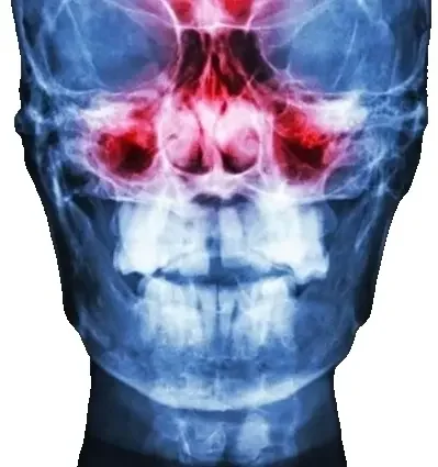 Фото для Рентгенография придаточных пазух носа