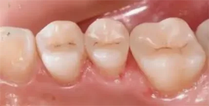 Лечение зубов (первичного кариеса) профессиональным стоматологом