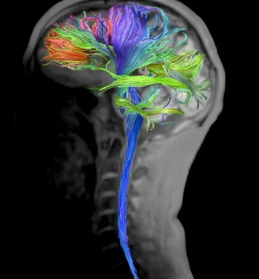 МРТ головного мозга с трактографией